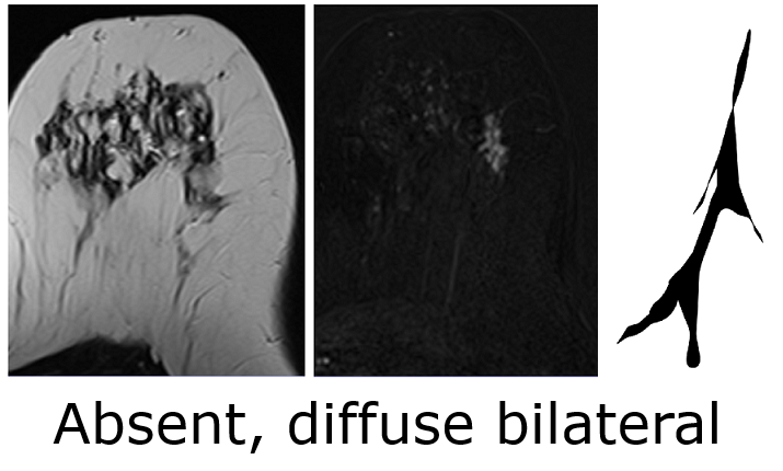 Absent, diffuse bilateral