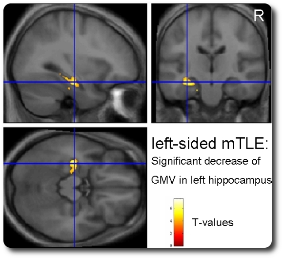 MRI, VBM