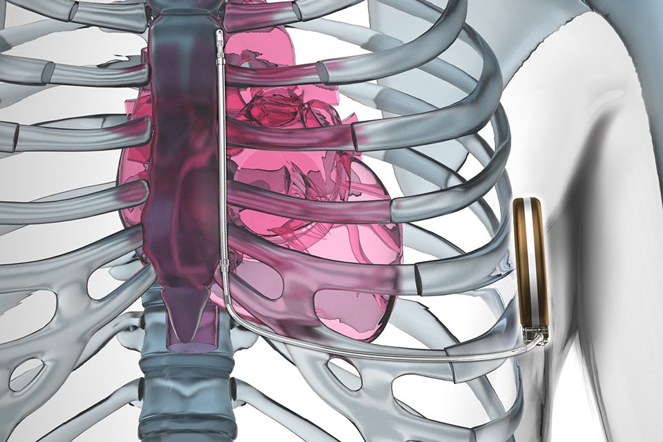 Subcutaneous defibrillator prevents sudden cardiac death