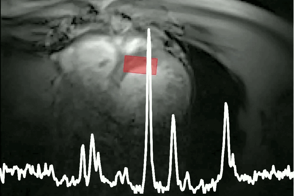 CINE MRI und 31P Spektra vom schlagenden Herzen