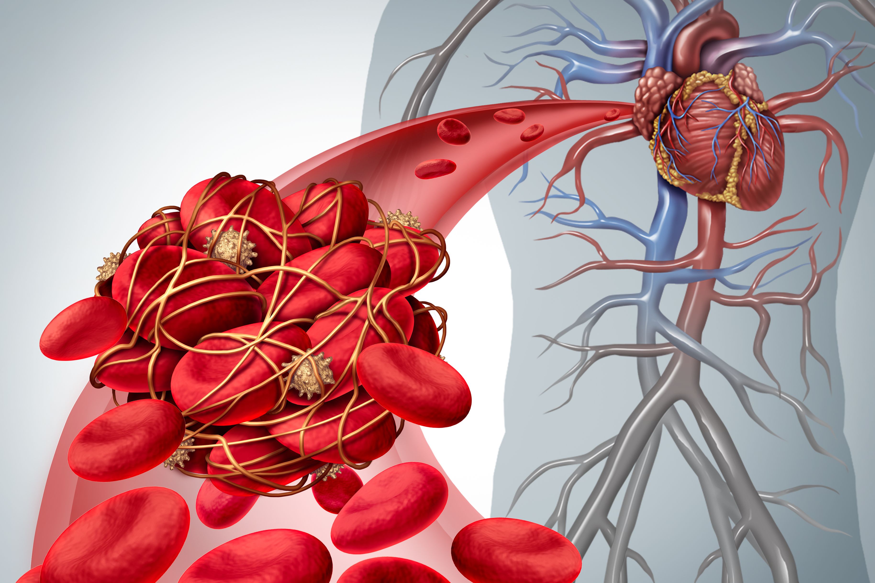 Thrombosen sind häufige Komplikationen bei Krebserkrankungen