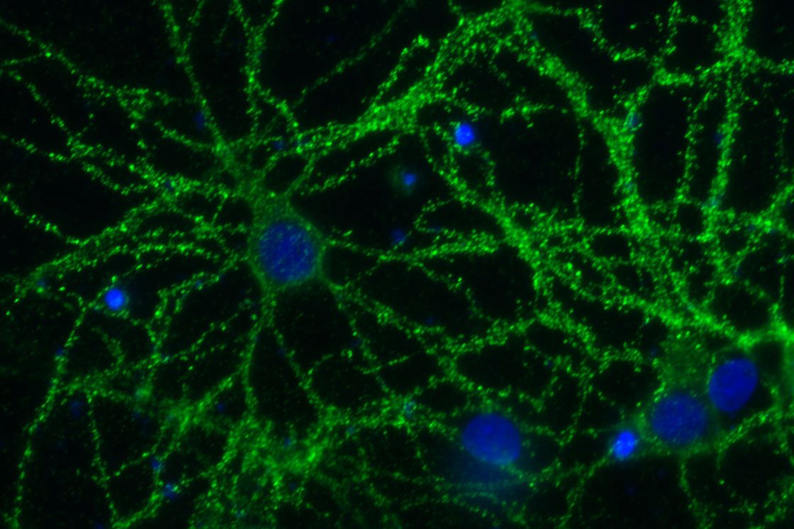 MedUni Vienna establishes the first diagnostic criteria for IgLON5 ...