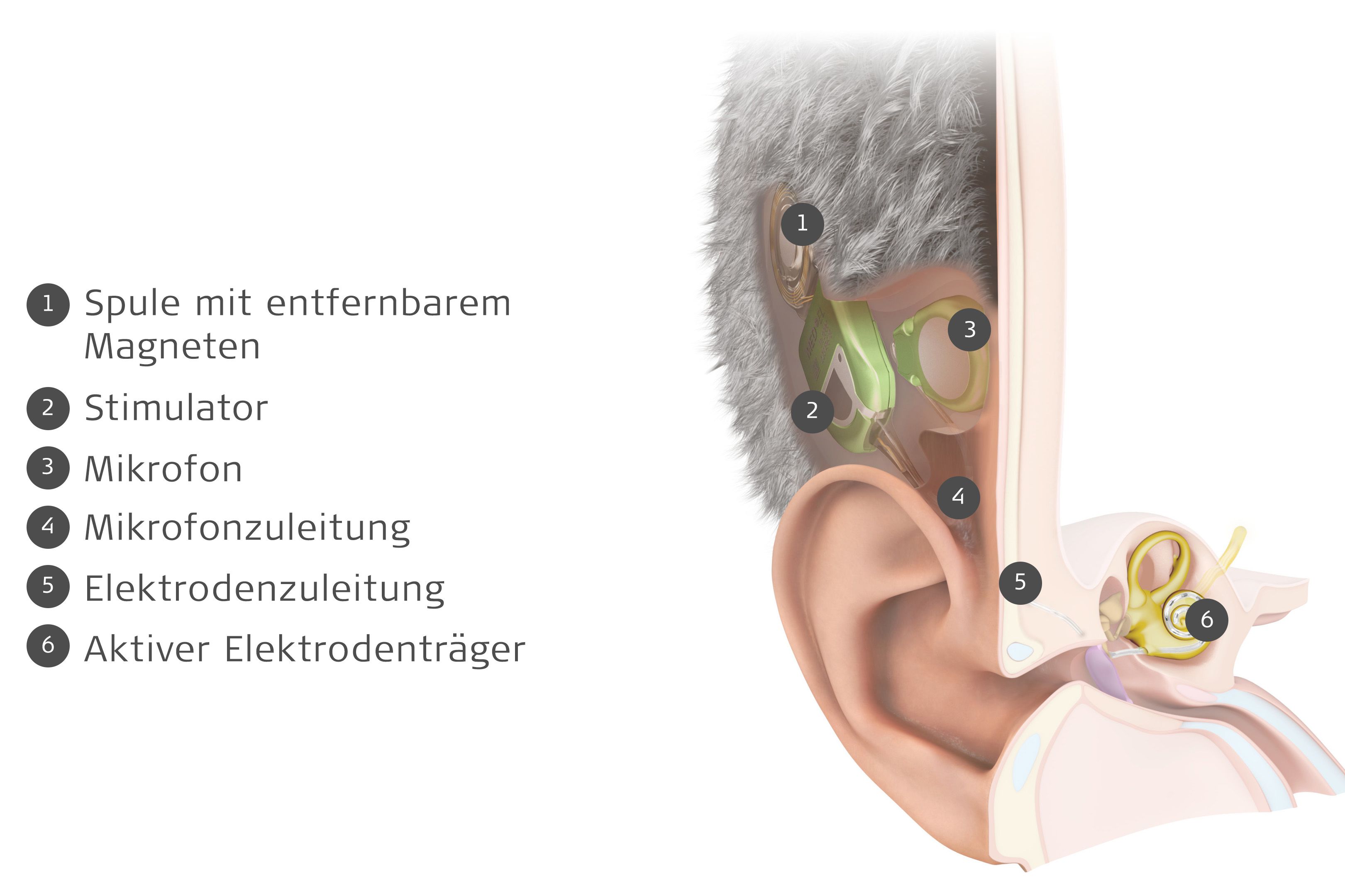 Bild: MED-EL