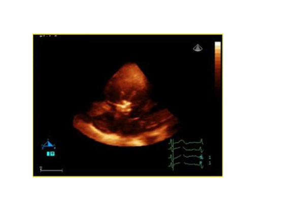 Ventricular septal defect (VSD) | MedUni Vienna