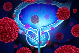 Risiko für neuerliches Karzinom nach Prostata-OP