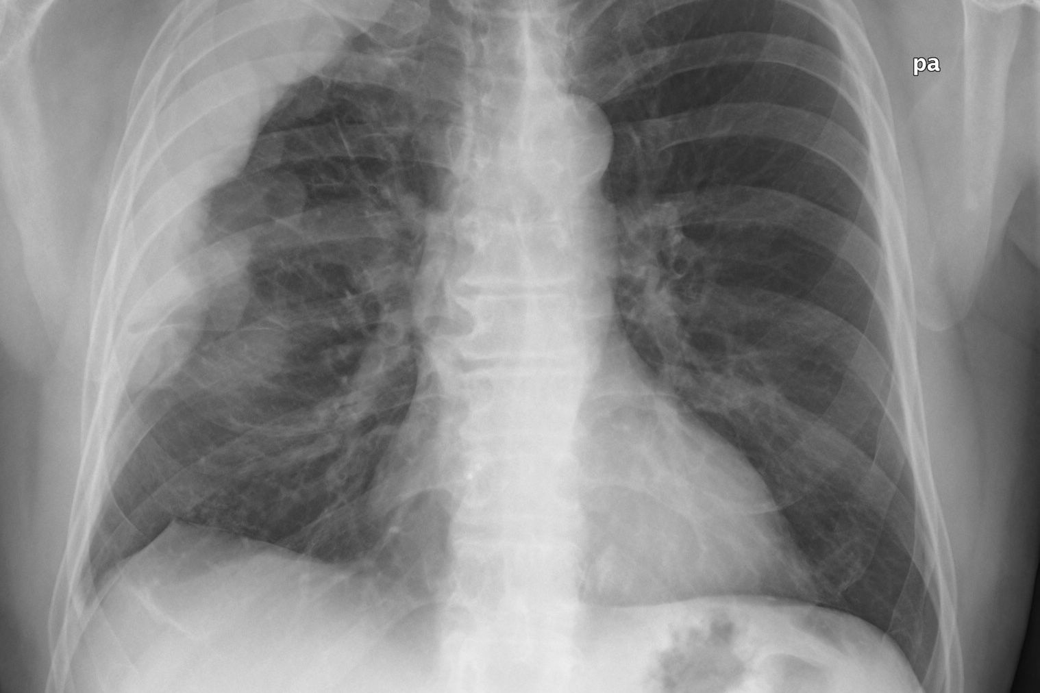 mesothelioma of intestine