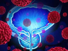 Krebszellen in einem männlichen Körper, die das Fortpflanzungssystem angreifen, als Symbol für die Behandlung und die Risiken des malignen Tumorwachstums beim Menschen ©Lightspring/shutterstock.com