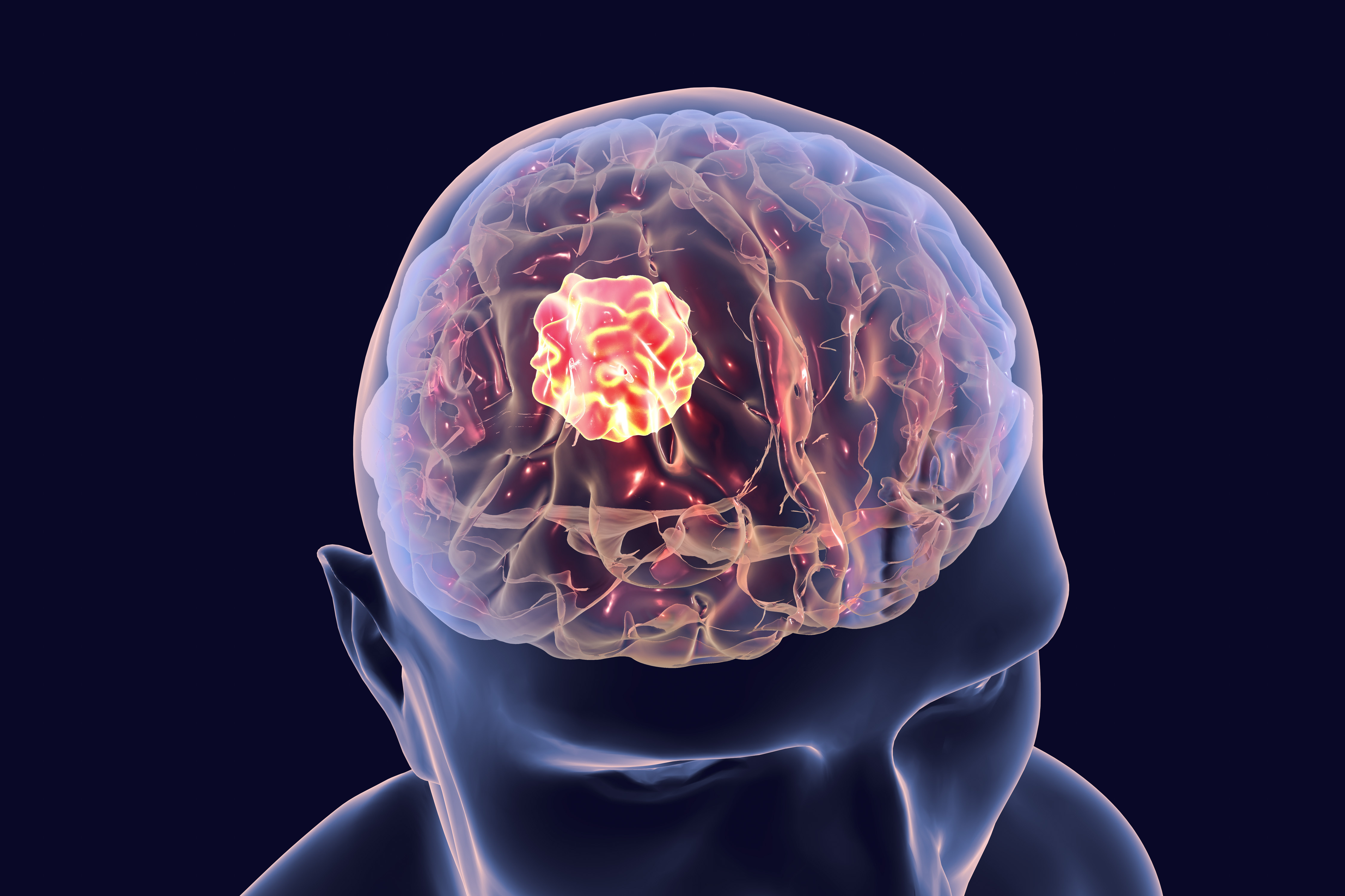 New marker for survival of glioblastoma patients discovered 